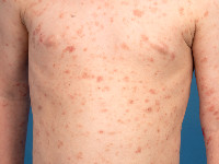 Pityriasis lichenoides chronica