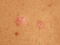 Pityriasis lichenoides chronica