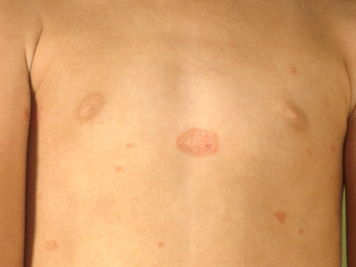 Pityriasis rosea