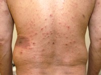 Pityriasis rosea