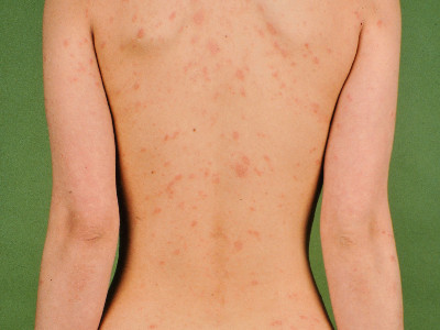 Pityriasis rosea