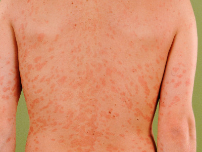 Pityriasis rosea