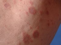 Pityriasis rosea