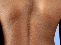 Pityriasis rosea in dennenboom configuratie