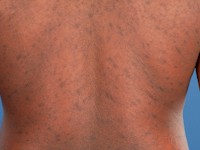 Pityriasis rosea in dennenboom configuratie