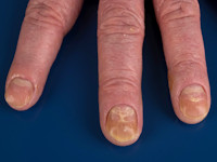 Histologie van pityriasis rubra pilaris