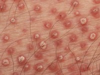 Pityriasis rubra pilaris