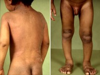 Pityriasis rubra pilaris