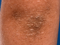Pityriasis rubra pilaris