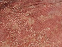 Pityriasis rubra pilaris