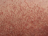 Pityriasis rubra pilaris