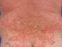 Pityriasis rubra pilaris