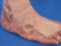 Pityriasis rubra pilaris