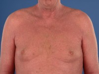 Pityriasis rubra pilaris