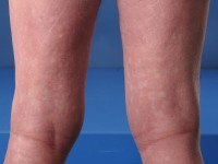 Erytrodermie met skipped lesions bij pityriasis rubra pilaris