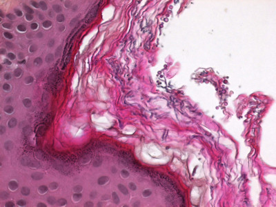 Pityrosporum gisten (Malassezia furfur)