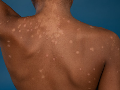 Pityriasis versicolor