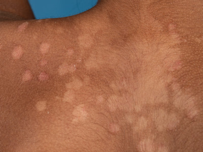 Pityriasis versicolor