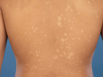 Pityriasis versicolor