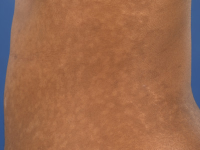 Pityriasis versicolor