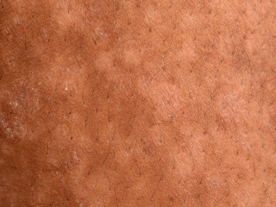 Pityriasis versicolor