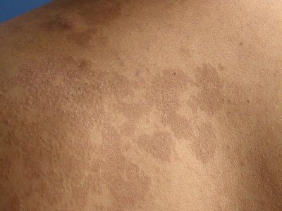 Pityriasis versicolor