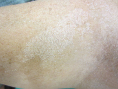 Pityriasis versicolor