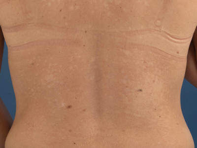 Pityriasis versicolor
