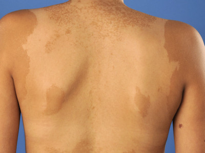 Pityriasis versicolor