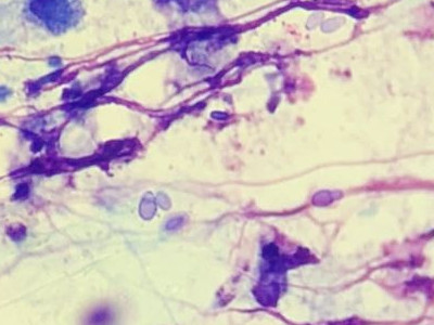Pityriasis versicolor