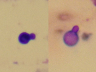 Pityrosporum yeasts (Malassezia furfur)