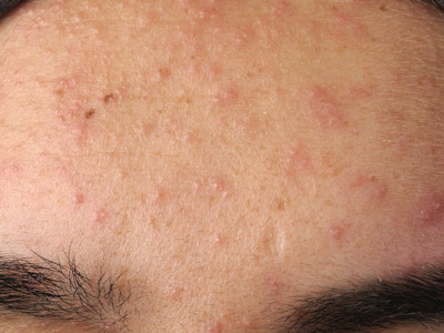Pityrosporum folliculitis (Malassezia furfur)