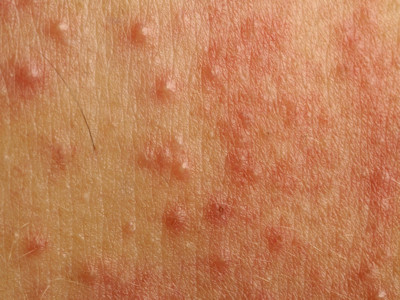 Pityrosporum folliculitis (Malassezia furfur)