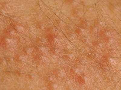 Pityrosporum folliculitis (Malassezia furfur)