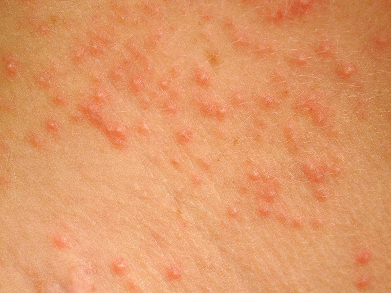 Folliculitis