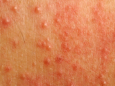 Pityrosporum folliculitis (Malassezia furfur)