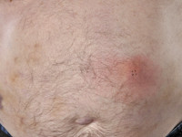 Plasmacytoma cutis