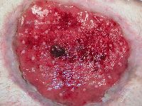 Punchgraft transplantatie bij platzbauch