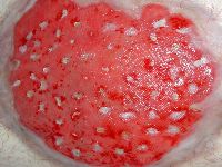 Punchgraft transplantatie bij platzbauch