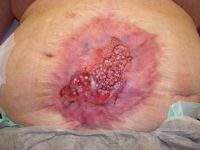 Punchgraft transplantatie bij platzbauch