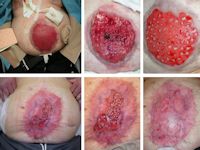 Punchgraft transplantatie bij platzbauch