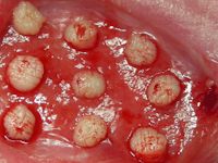 Punchgraft transplantatie bij platzbauch