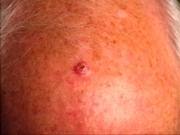 Squamous cell carcinoma, carcinoma squamous cell carcinoma