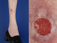 Squamous cell carcinoma, carcinoma squamous cell carcinoma