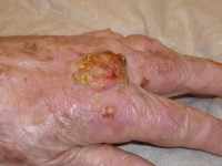 Squamous cell carcinoma, carcinoma squamous cell carcinoma