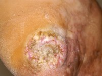 Squamous cell carcinoma arising from a chronic ulcer