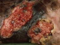 Plaveiselcelcarcinoom ontstaan in een chronisch ulcus