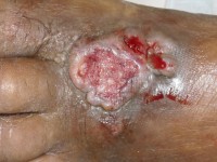 Squamous cell carcinoma arising from a chronic ulcer
