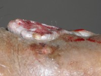 Plaveiselcelcarcinoom ontstaan in een chronisch ulcus