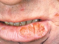 Squamous cell carcinoma, carcinoma squamous cell carcinoma